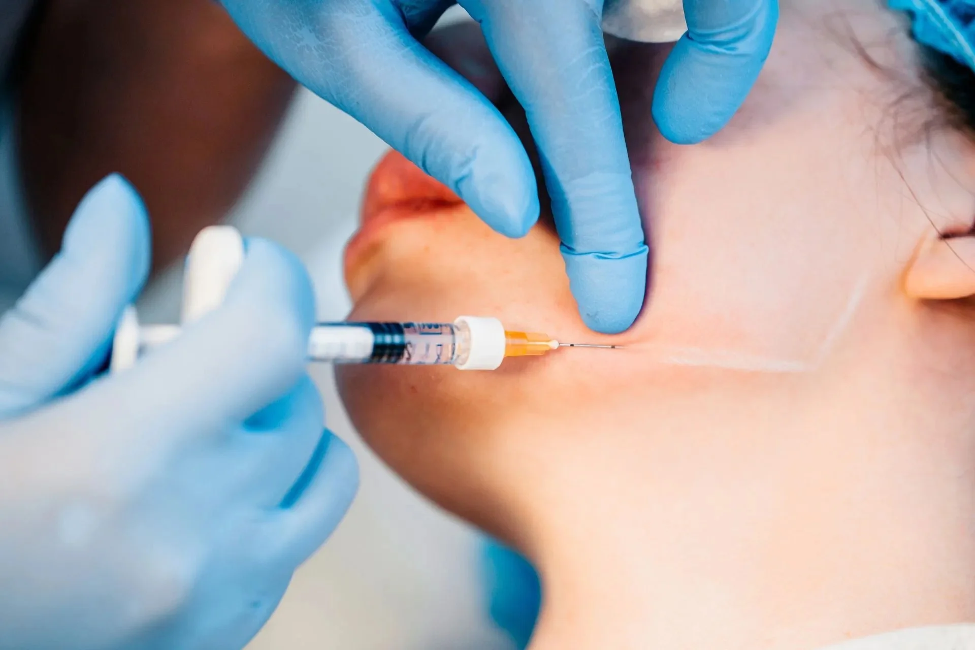 Microneedling-Behandlung zur Hautverjüngung